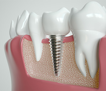 Implant Dentistry Near Me in Wrentham MA Area